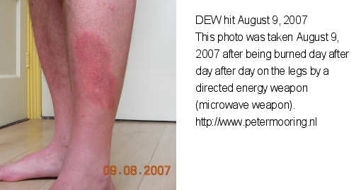 directed energy weapon hit